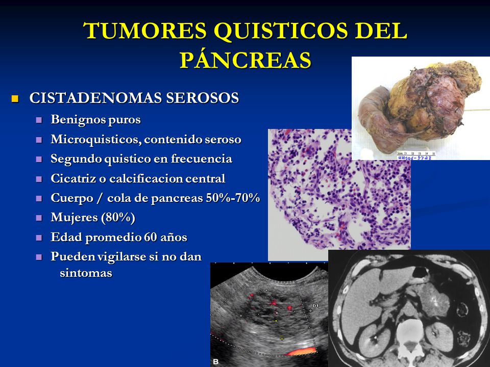tumor de páncreas síntomas benignos de diabetes